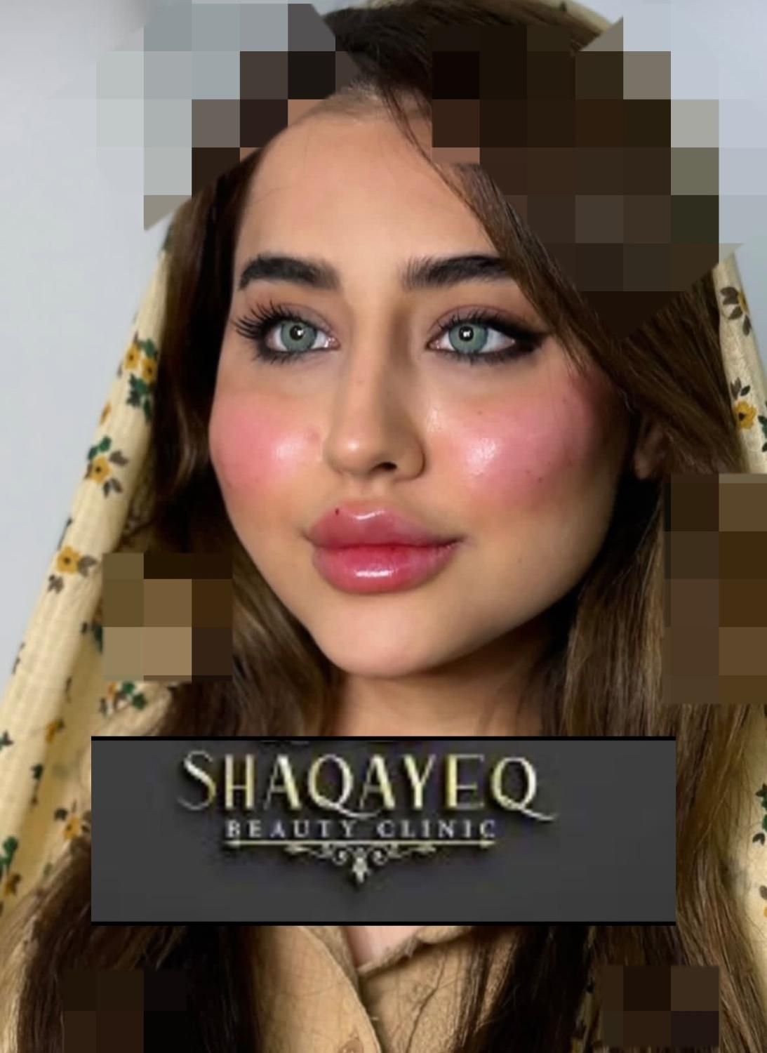 تزریق تخصصی ژل ومادلینگ وبوتاکس وهایفو|خدمات آرایشگری و زیبایی|کرمانشاه, |دیوار