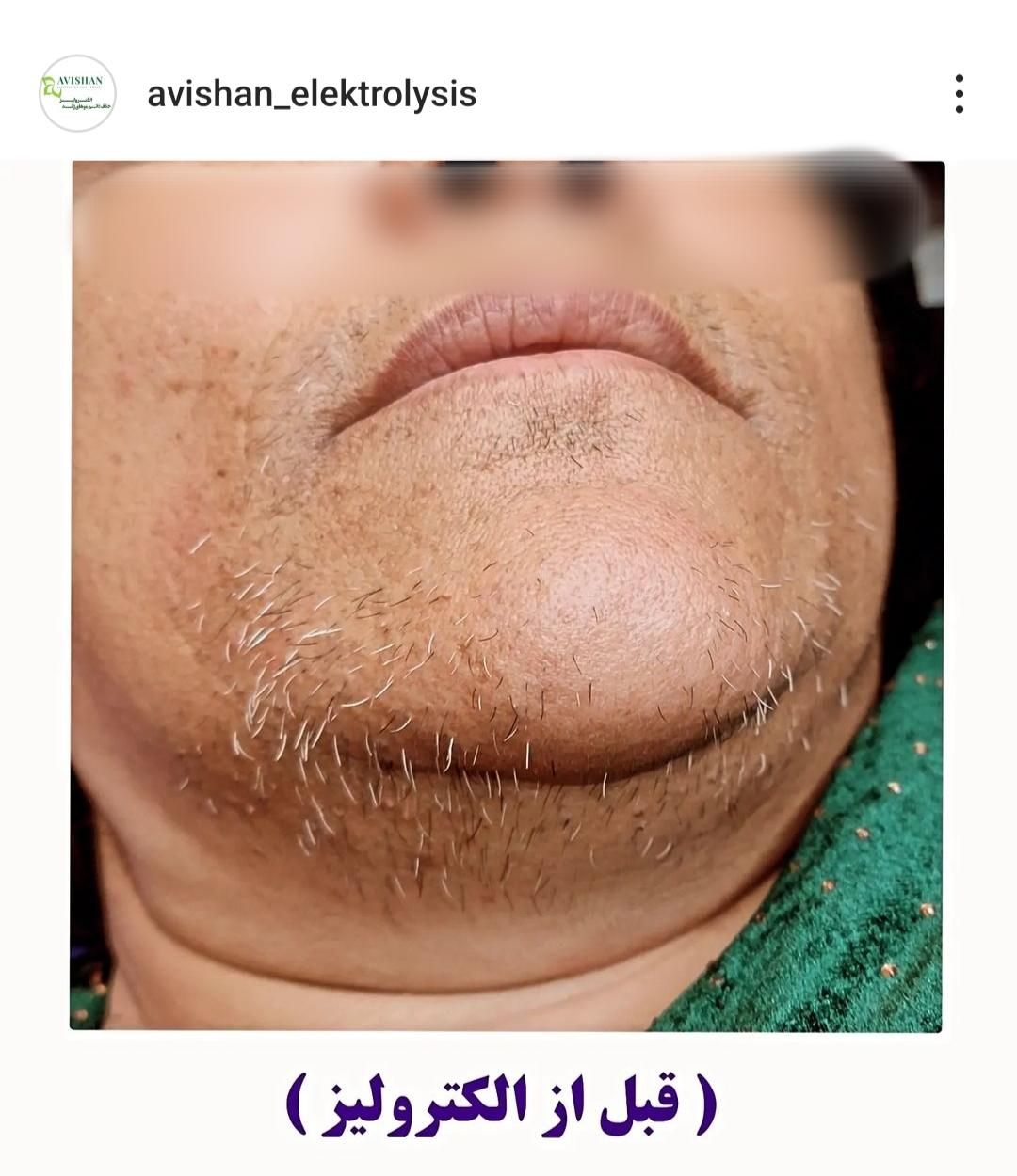 تخفیف الکترولیز،(×لیزر نیست) حذف دائم موهای زائد|خدمات آرایشگری و زیبایی|یاسوج, |دیوار