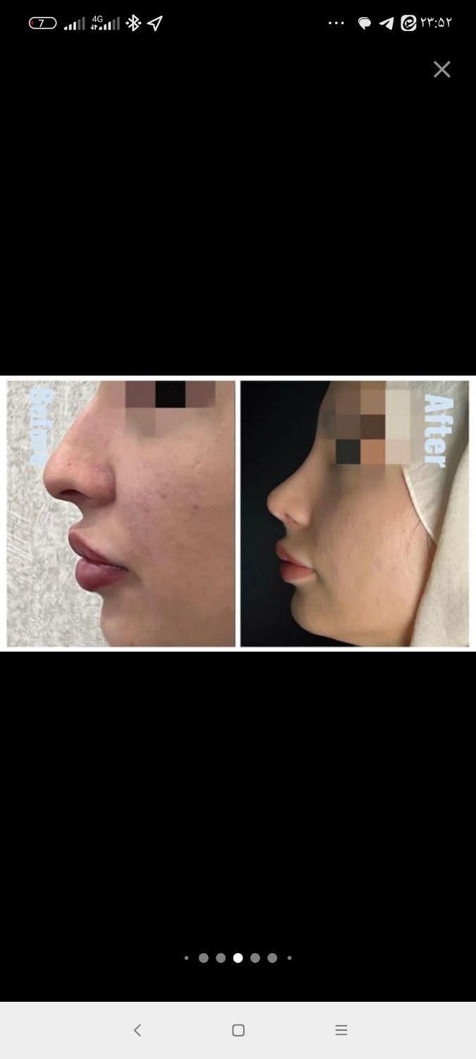 جراحی رینوپلاستی۲۷زیبایی بینی|خدمات آرایشگری و زیبایی|قم, بلوار امین و ساحلی|دیوار