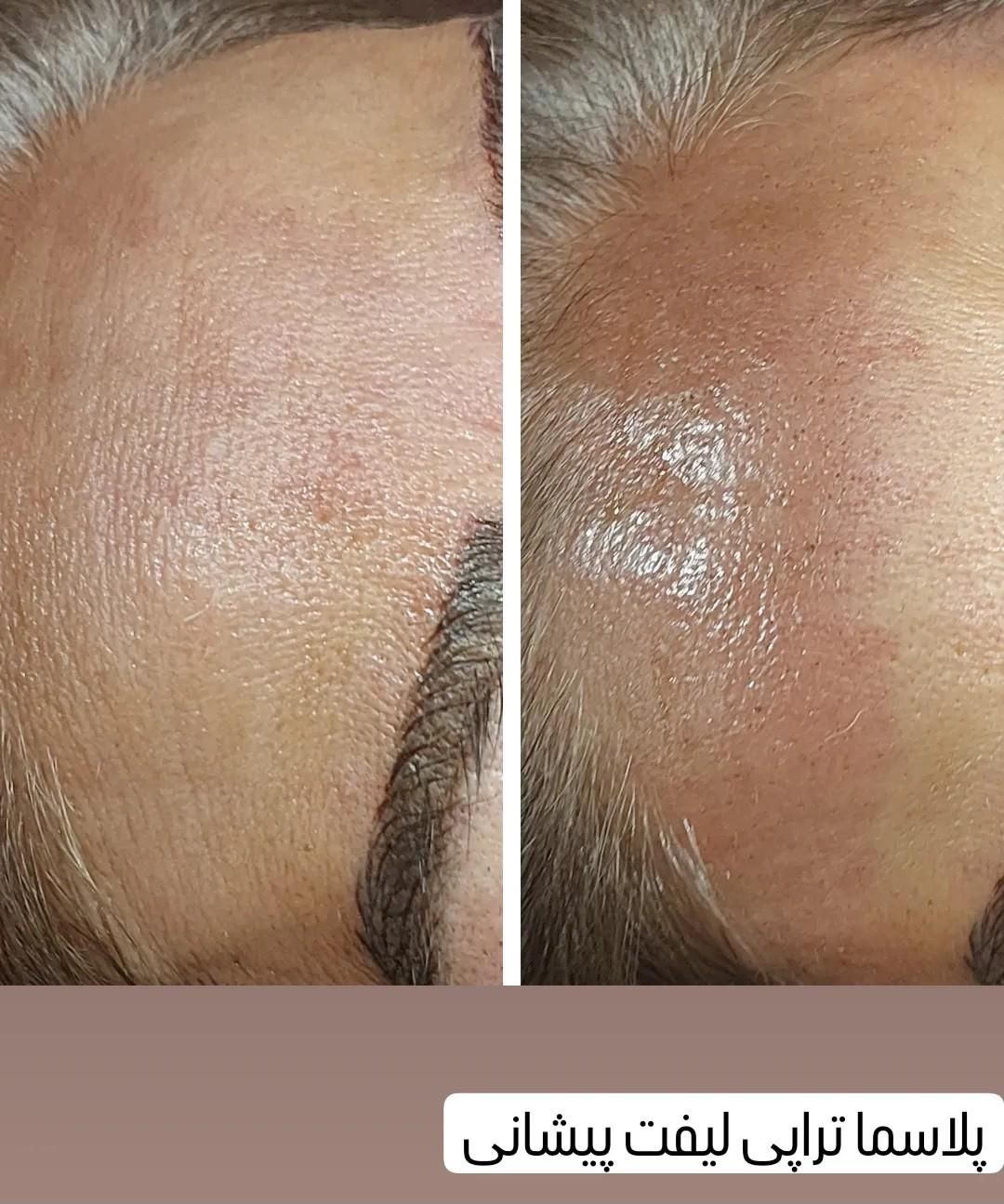 پلکسر مزو میکرونیلدینگ  رفع خال جوانسازی فیشیال|خدمات آرایشگری و زیبایی|مشهد, طلاب|دیوار