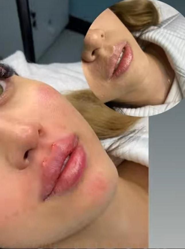 تزریق ژل.بوتاکس.انزیم.چال لپ‌.مزوپیرسینگ|خدمات آرایشگری و زیبایی|فردیس, فردیس|دیوار