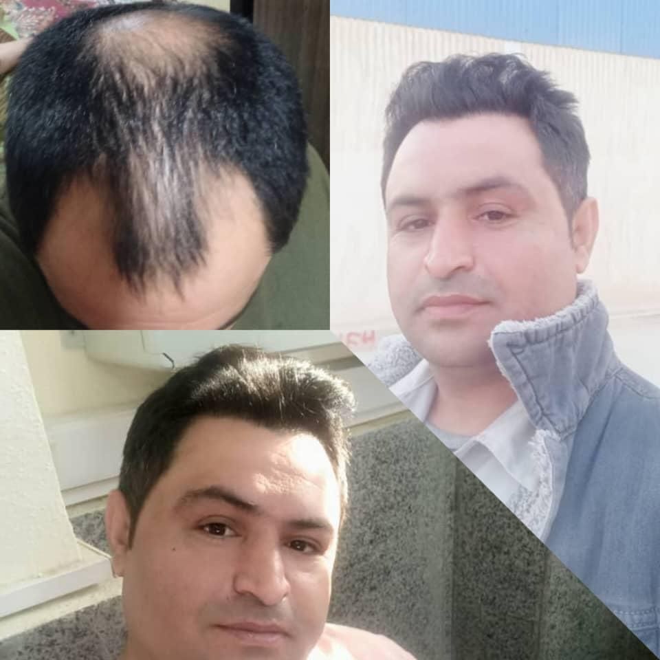 کاشت ابرو وموی طبیعی|خدمات آرایشگری و زیبایی|بوشهر, |دیوار