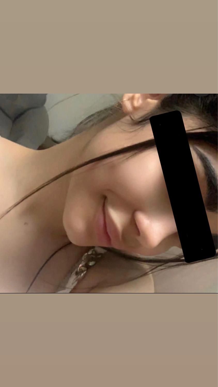 جراحی زیبایی بینی فقط با 22 میلیون|خدمات آرایشگری و زیبایی|قائم‌شهر, |دیوار