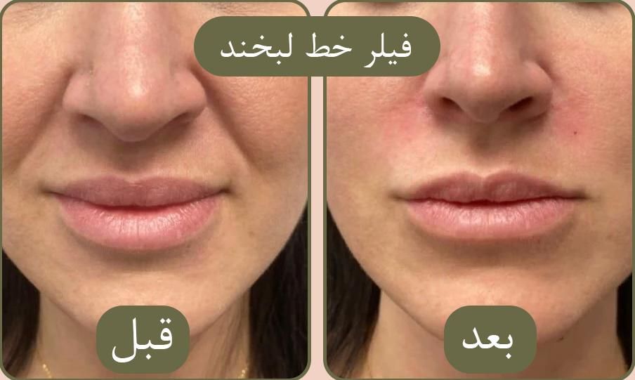 جشنواره بوتاکس،فیلر،‌لب روسی،جوانسازی،توسط پزشک|خدمات آرایشگری و زیبایی|زنجان, |دیوار