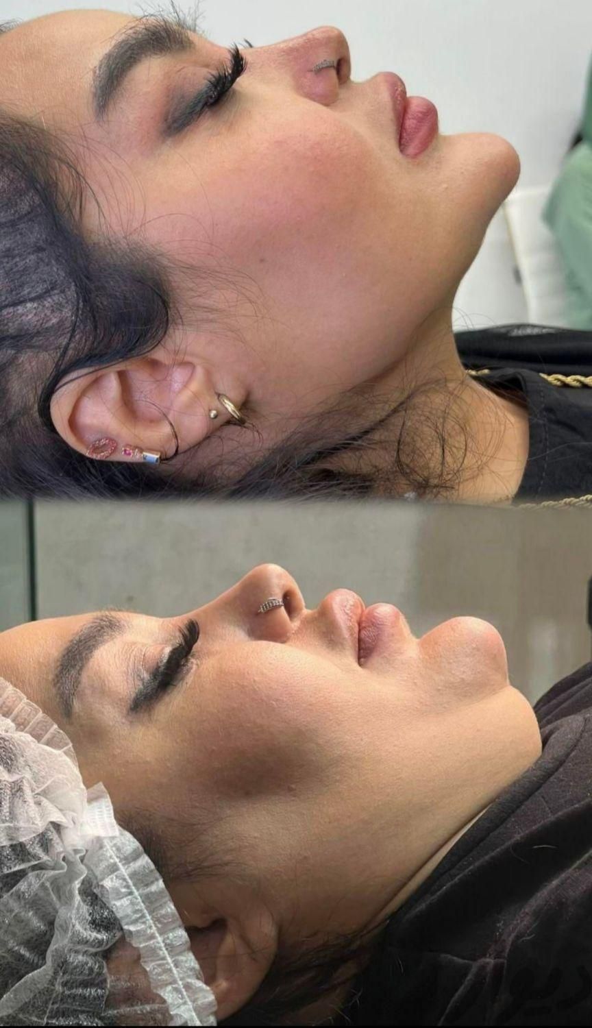 مرکزلیپوساکشن‌ و ساکشن غبغب و زاویه سازی توسط جراح|خدمات آرایشگری و زیبایی|مشهد, سناباد|دیوار