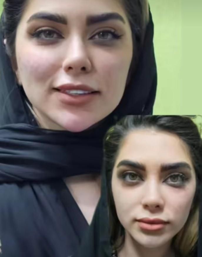 تزریق چربی|خدمات آرایشگری و زیبایی|کرمانشاه, |دیوار