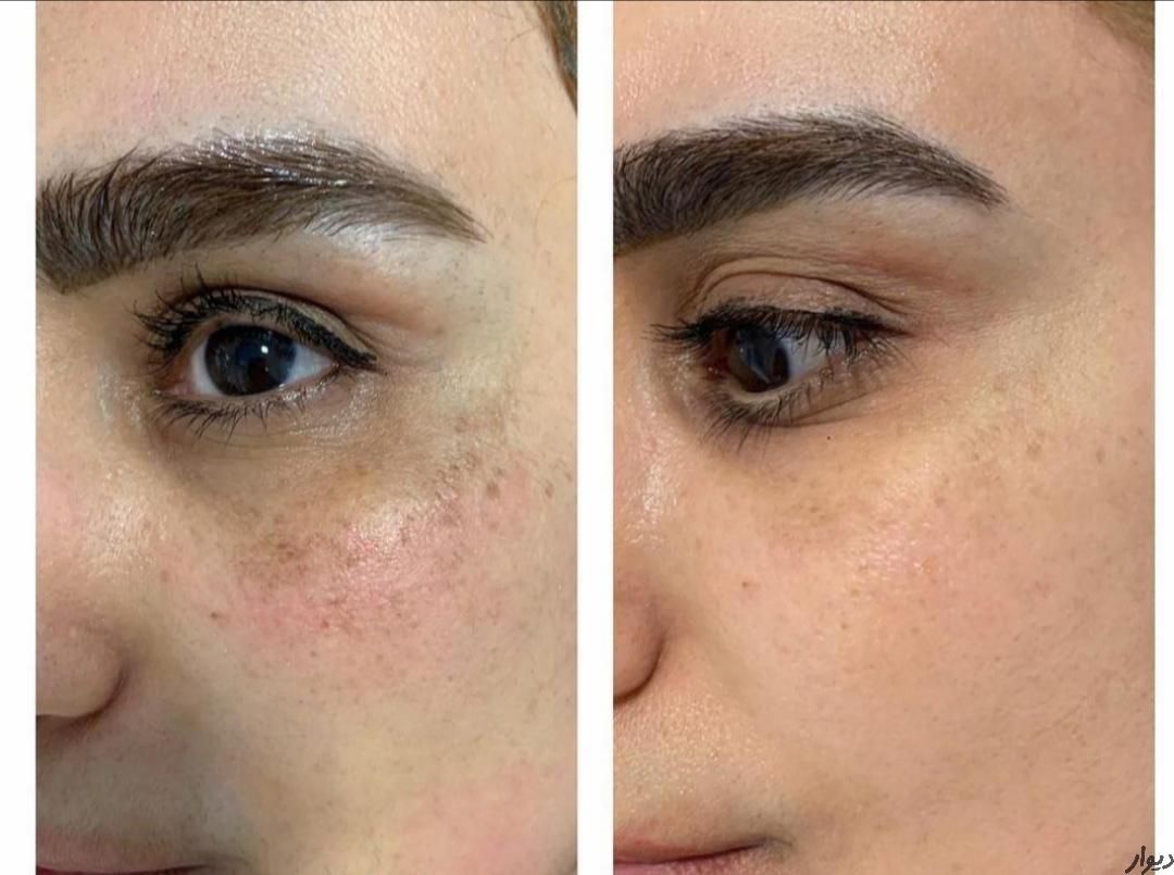 لیزر کک مک خال لیفت لمینت پاکسازی مژه ناخن ژل|خدمات آرایشگری و زیبایی|خرم‌آباد, |دیوار
