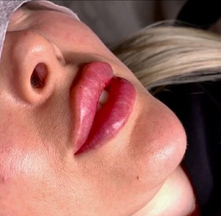 ژل لب روسی/بوتاکس/فیلر زیر چشم/زاویه فک لیزر بدن|خدمات آرایشگری و زیبایی|تهران, ستارخان|دیوار