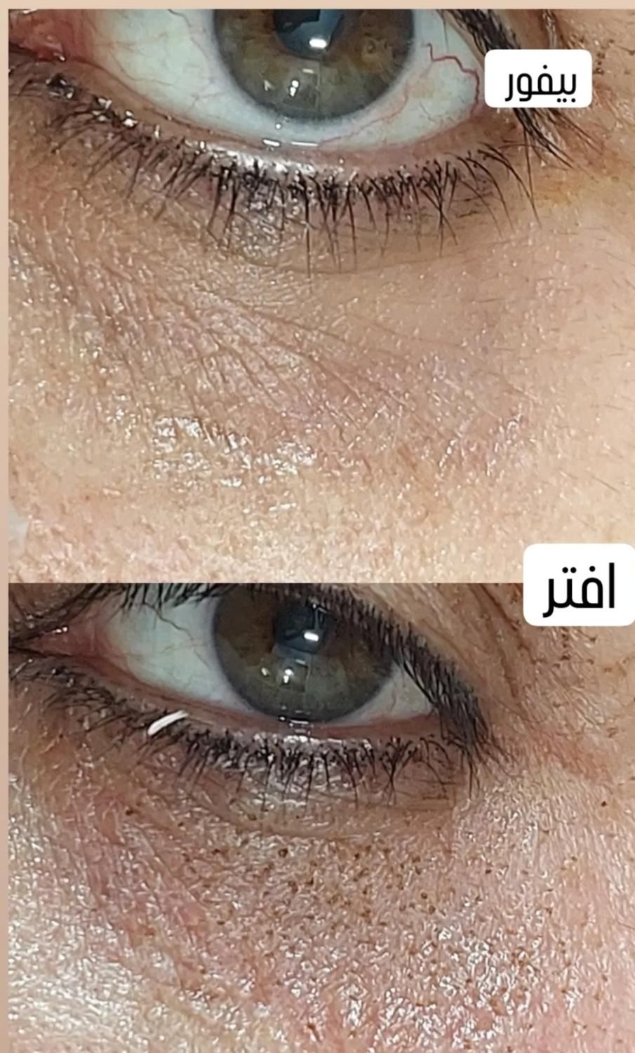 پلکسر مزو میکرونیلدینگ  رفع خال جوانسازی فیشیال|خدمات آرایشگری و زیبایی|مشهد, طلاب|دیوار