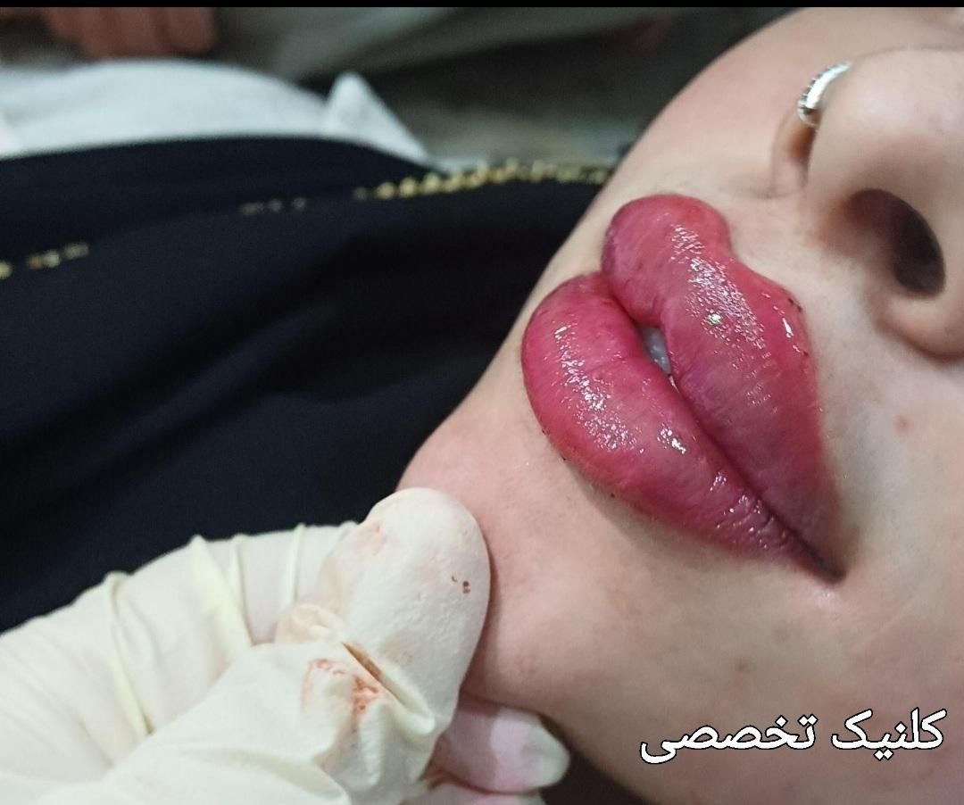 تزریق ژل و بوتاکس و کاشت نخ در کلینیک زیبایی|خدمات آرایشگری و زیبایی|خرم‌آباد, |دیوار