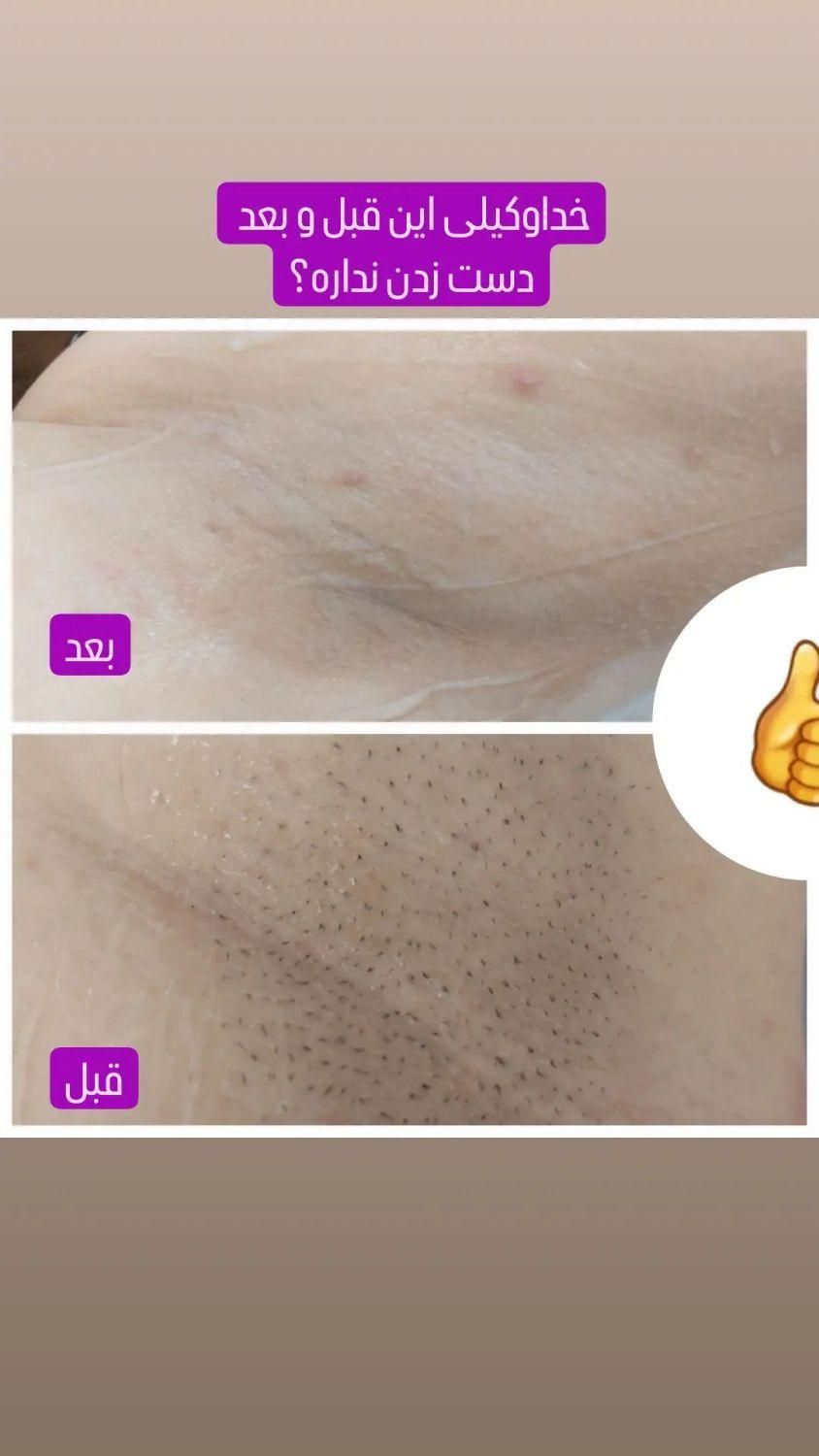 جشنواره بهاری لیزر موی زائد فول ۴۲۰ به مدت محدود|خدمات آرایشگری و زیبایی|ارومیه, |دیوار