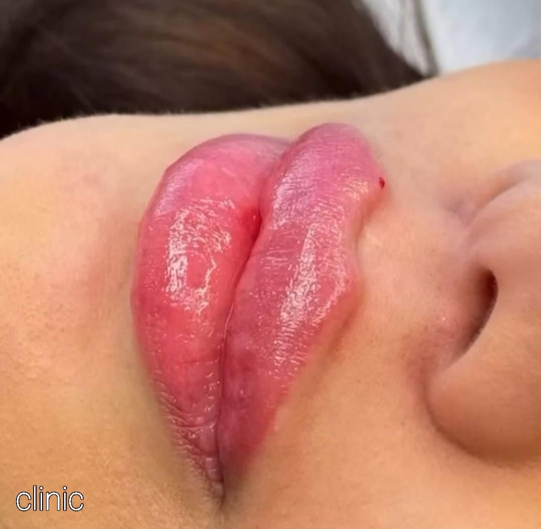 تزریق ژل و بوتاکس و کاشت نخ در کلینیک زیبایی|خدمات آرایشگری و زیبایی|خرم‌آباد, |دیوار