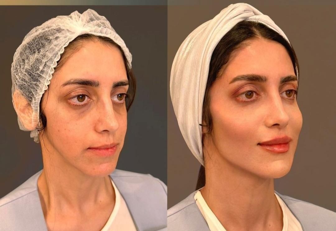 اصلاح فرم صورت.جوانسازی به روش یانگ فیس توسط متخصص|خدمات آرایشگری و زیبایی|مشهد, سناباد|دیوار