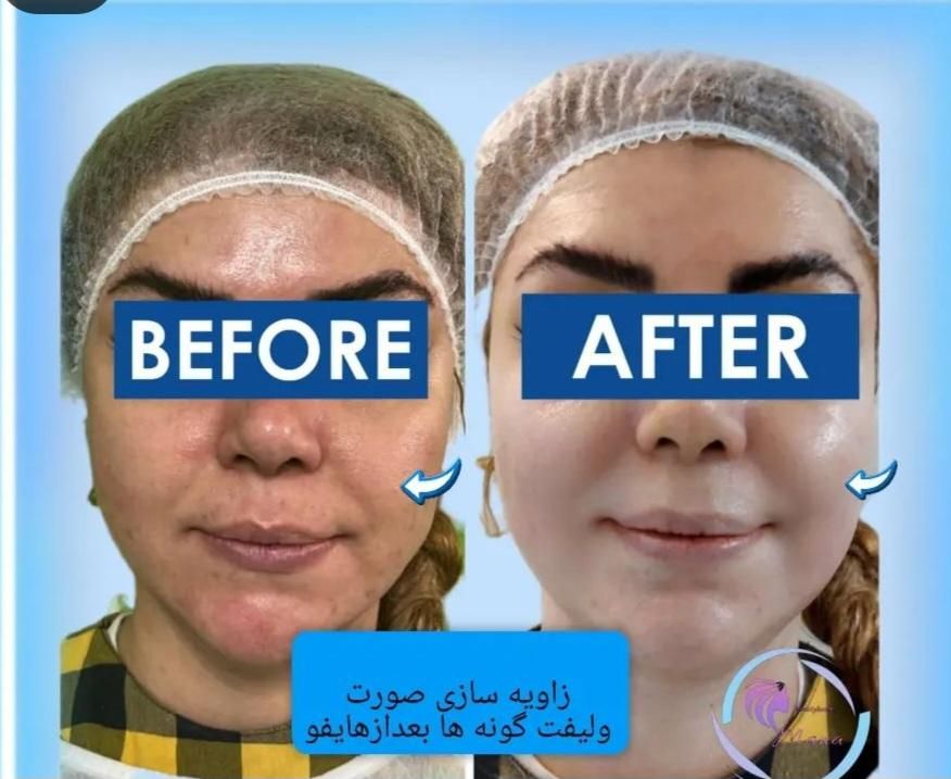 هایفوتراپی،لیفت وجوانسازی صورت،رفع غبغب|خدمات آرایشگری و زیبایی|تهران, ظفر|دیوار