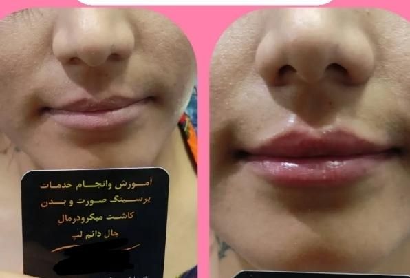 جشنواره آموزش پیرسینگ میکرو چال هیدن ژل بوتاکس ا|خدمات آرایشگری و زیبایی|مشهد, رضاشهر|دیوار
