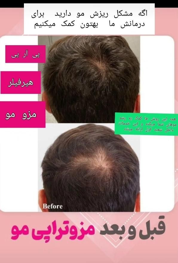 درمان تخصصی ریزش و قطع ریزش مو در کلینیک تخصصی|خدمات آرایشگری و زیبایی|برازجان, |دیوار