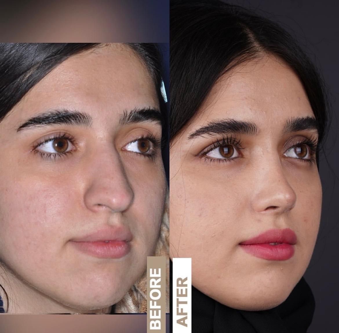 جراحی بینی ابدو ساکشن بلفارو غبغب تیپ پلاستی|خدمات آرایشگری و زیبایی|مشهد, احمدآباد|دیوار