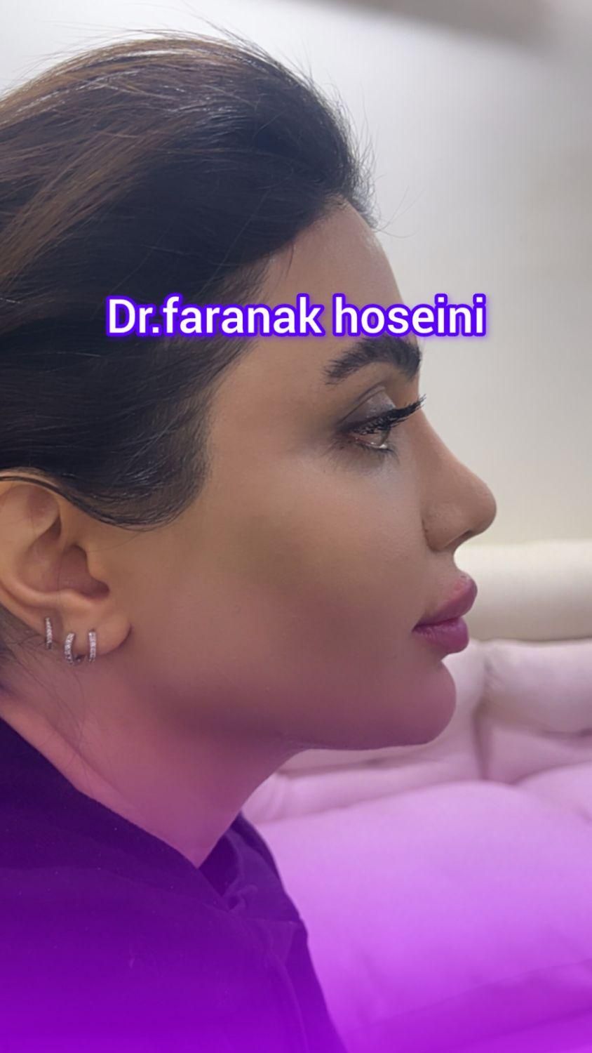 تخفیف تزریق ژل بوتاکس هایفولیزر فیلربادی لیفت بانخ|خدمات آرایشگری و زیبایی|تهران, ستارخان|دیوار
