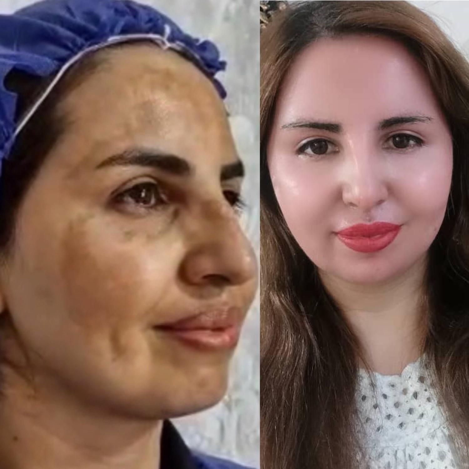 ازبین بردن لک ،کک ومک،جوانسازی|خدمات آرایشگری و زیبایی|دهدشت, |دیوار