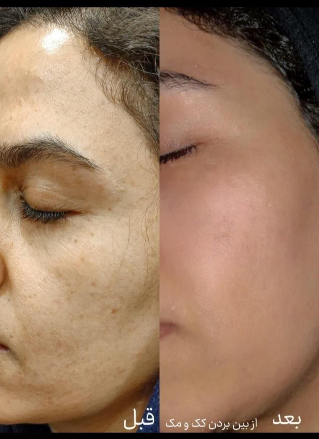 پوست صاف ویکدست میخوای متن آگهی روبخون+پیشنهادویژه|خدمات آرایشگری و زیبایی|قم, باجک دو|دیوار