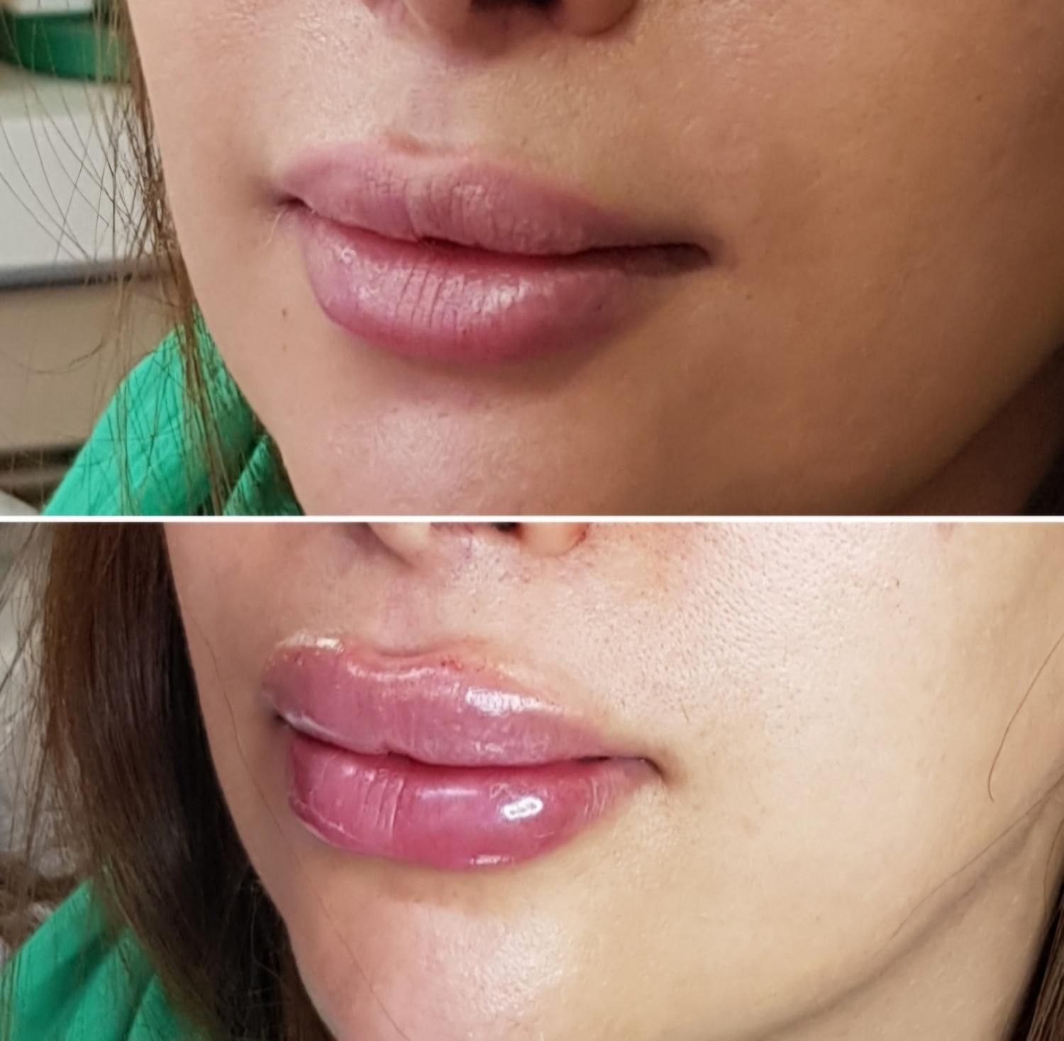 بوتاکس ژل فیلر مزوتراپی لیزر هایفو لیفت نخ در مطب|خدمات آرایشگری و زیبایی|اصفهان, مسجد مصلی|دیوار