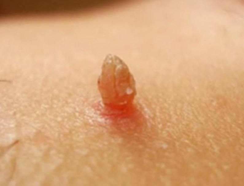 زگیل تناسلیhpv/میخچه/زیگیل/خال/بواسیر هموروئید|خدمات آرایشگری و زیبایی|تهران, دانشگاه علم و صنعت|دیوار