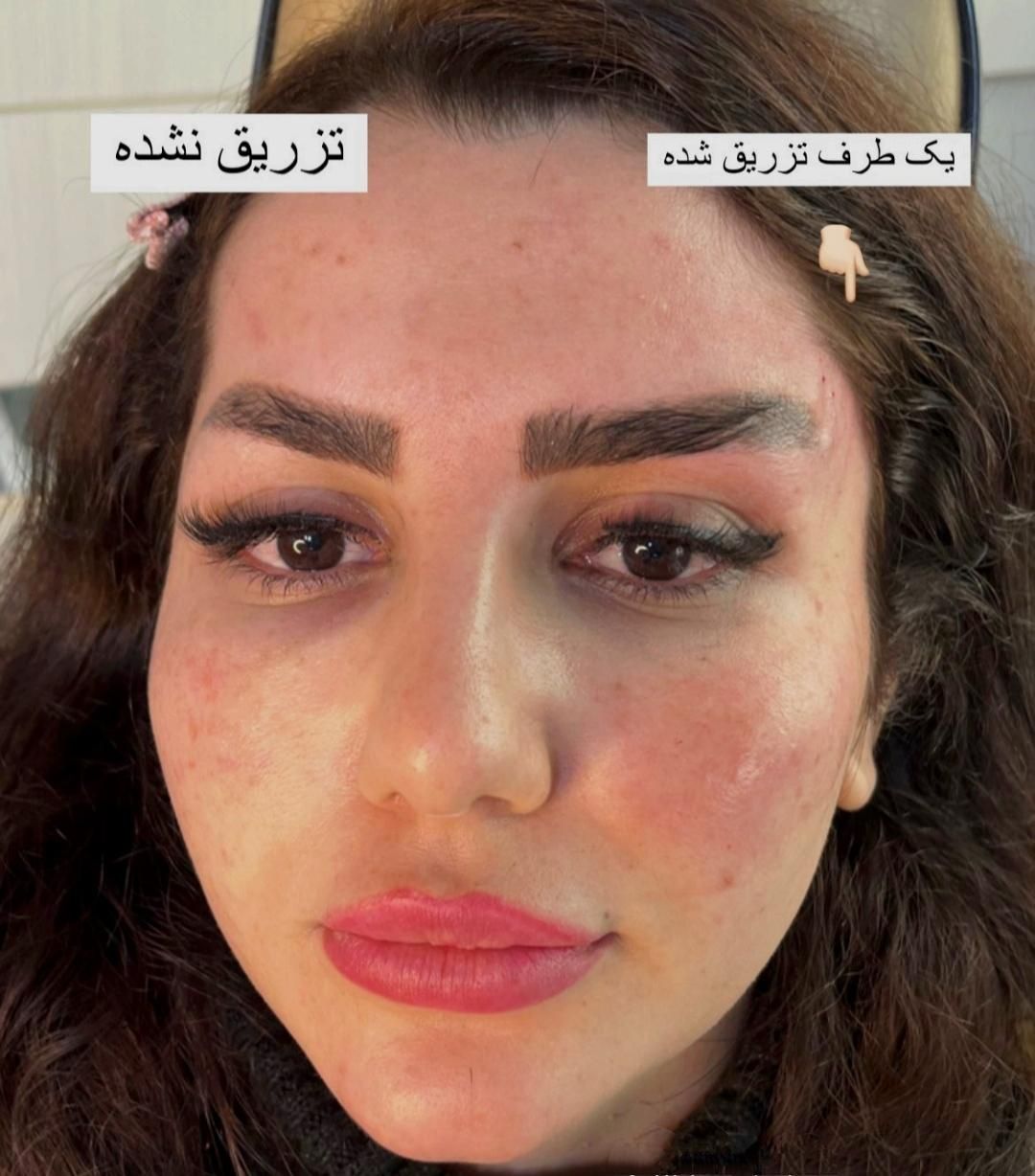 تزریق فیلر صورت مطابق المانهای زیبایی شناسی|خدمات آرایشگری و زیبایی|ورامین, |دیوار