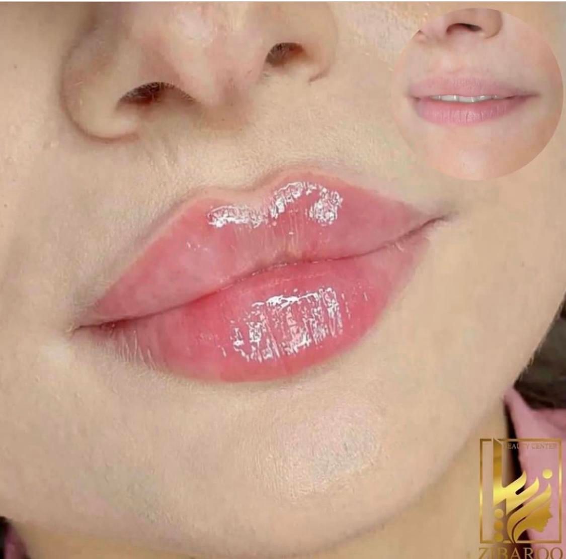 تزریق فیلر زیر چشم ژل لب روسیm کلینیک تخصصی لیفت|خدمات آرایشگری و زیبایی|تهران, صادقیه|دیوار