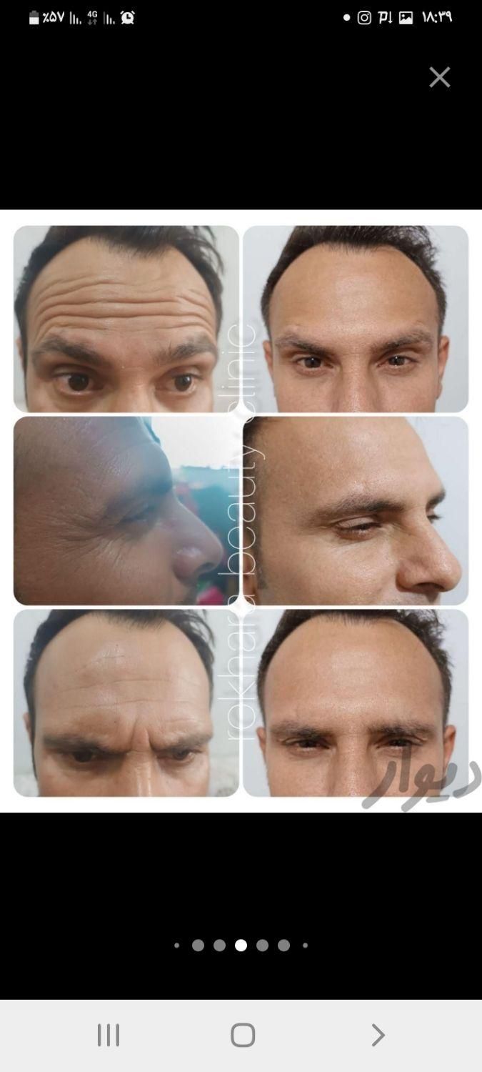 جشنواره پاییزه تزریق ژل وبوتاکس توسط پزشک متخصص|خدمات آرایشگری و زیبایی|بندرعباس, |دیوار