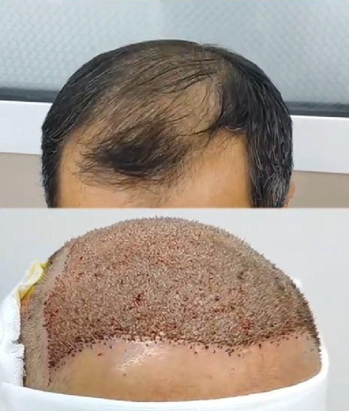 کاشت مو، ابرو، ریش حرفه ای توسط پزشک متخصص پوست مو|خدمات آرایشگری و زیبایی|شیراز, قدوسی غربی|دیوار