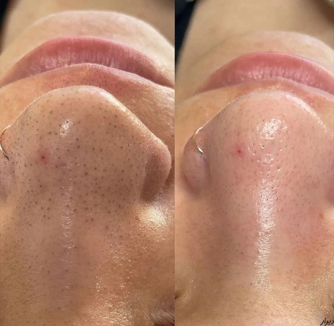 لیزر کک مک خال لیفت لمینت پاکسازی مژه ناخن ژل|خدمات آرایشگری و زیبایی|خرم‌آباد, |دیوار