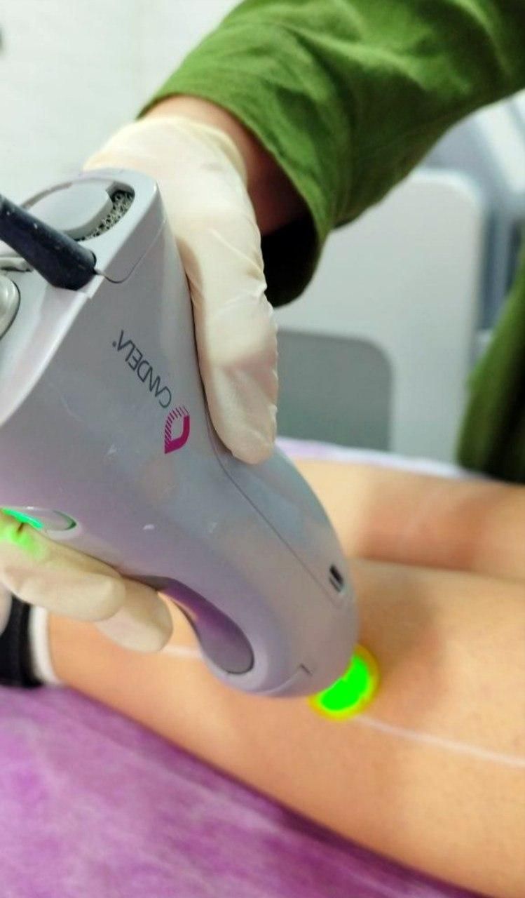 لیزر موی زائد الکس کندلا آمریکایی 2022 (شوش)|خدمات آرایشگری و زیبایی|شوش, |دیوار