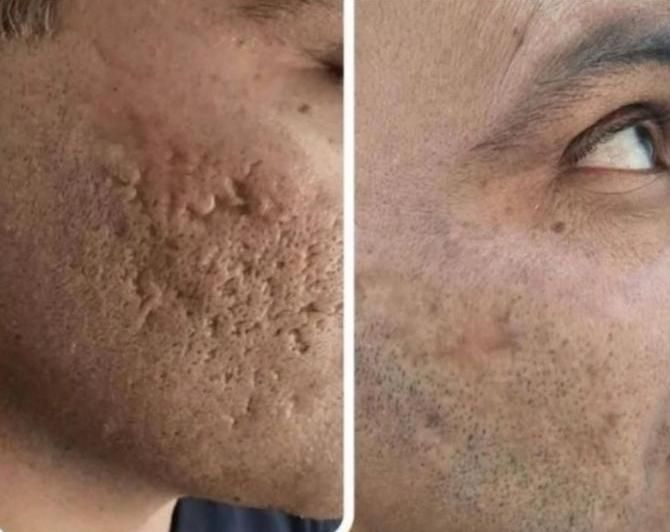 درمان تضمینی وماندگار تو رفتگی پوستی/جای جوش/اسکار|خدمات آرایشگری و زیبایی|اصفهان, باغ دریاچه|دیوار