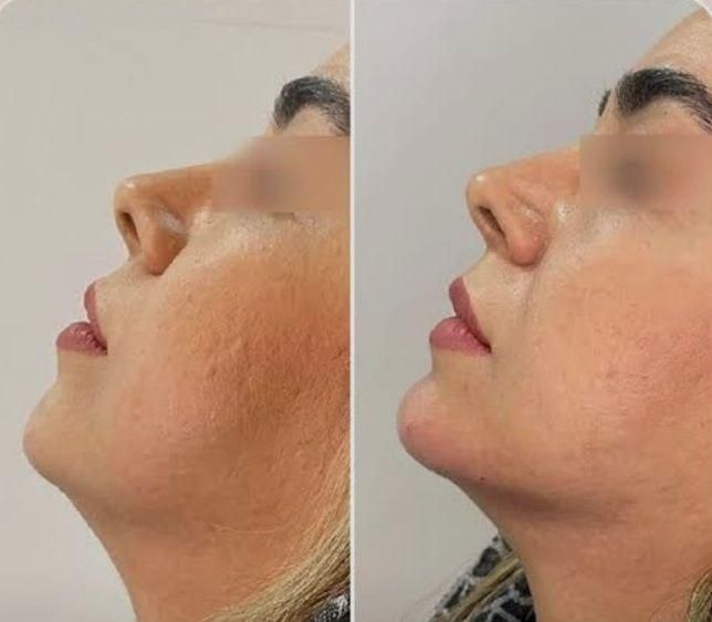 تزریق ژل و بوتاکس و کاشت نخ در کلینیک زیبایی|خدمات آرایشگری و زیبایی|خرم‌آباد, |دیوار
