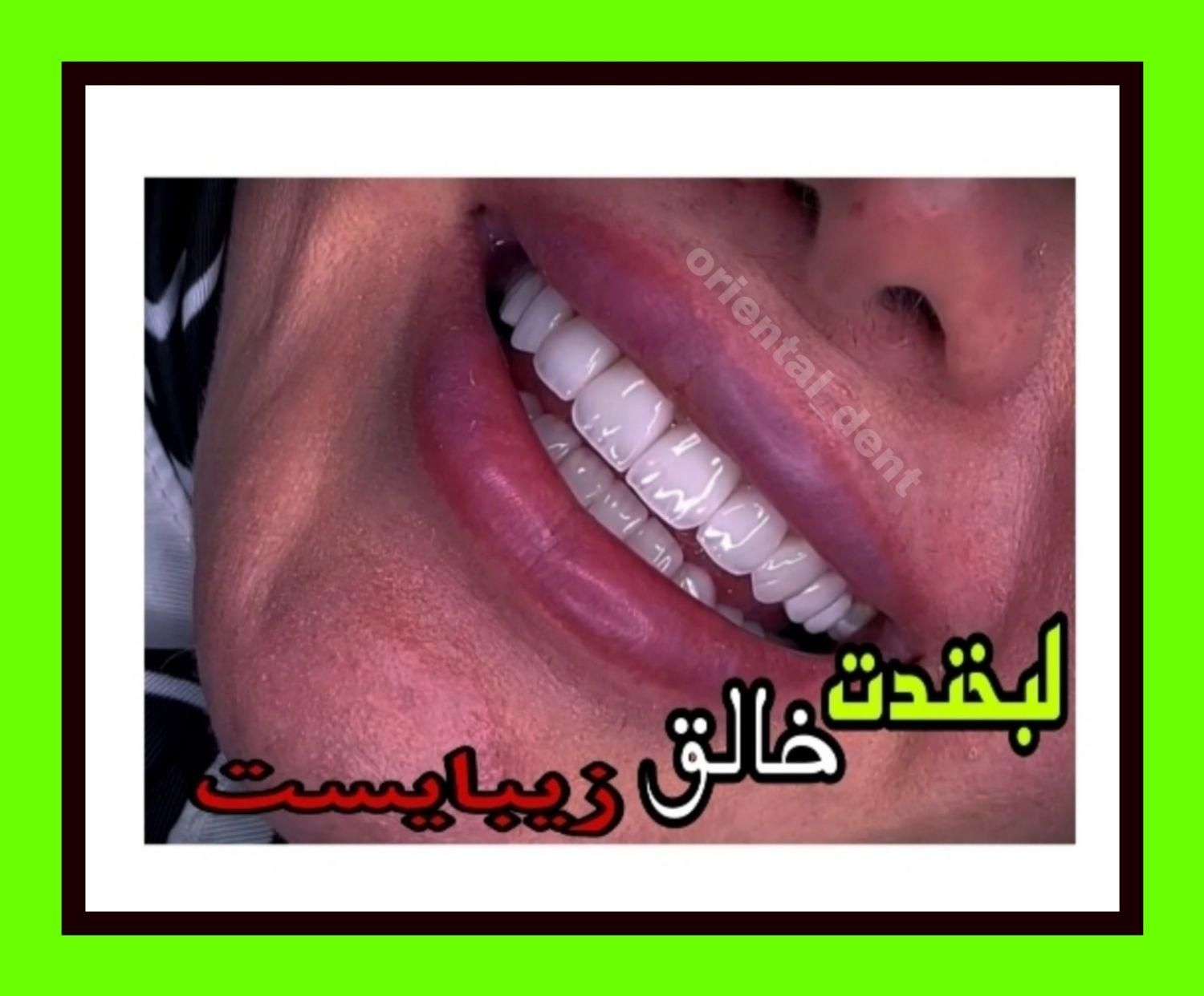 کامپوزیت دندان/دندانپزشکی/ترمیم/عصبکشی/لمینیت|خدمات آرایشگری و زیبایی|تهران, تهرانپارس شرقی|دیوار