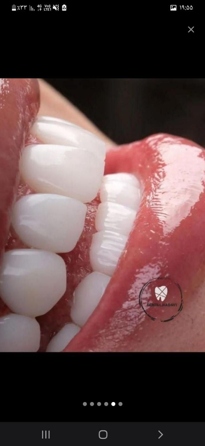 آموزش دندانپزشکی و کامپوزیت . لمینت .ترمیم|خدمات آموزشی|اسلام‌شهر, |دیوار