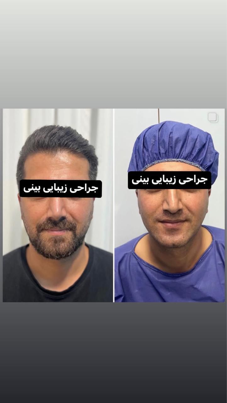 جراحی زیبایی بینی فقط با 22 میلیون|خدمات آرایشگری و زیبایی|قائم‌شهر, |دیوار