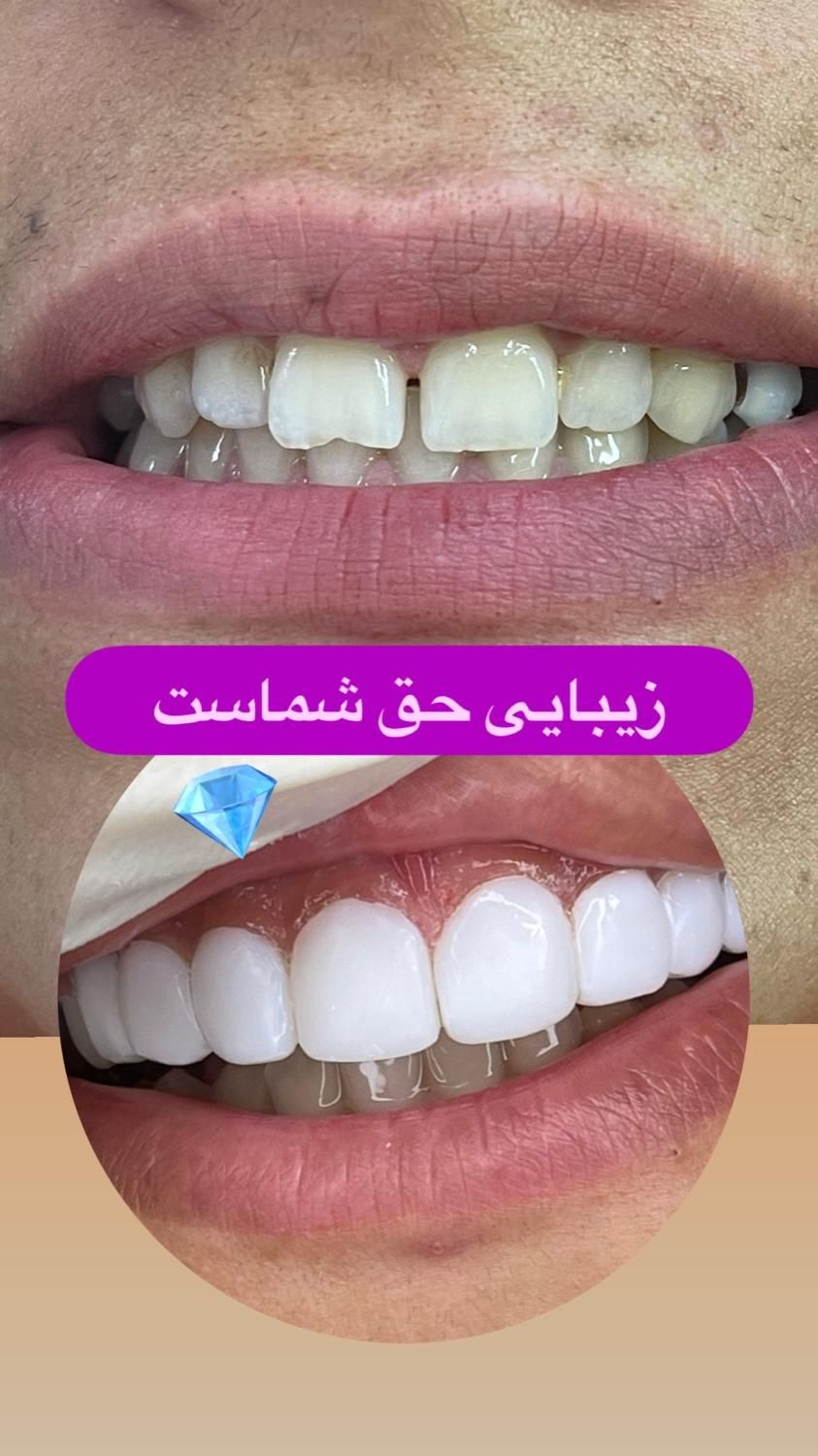 کامپوزیت دندان|خدمات آرایشگری و زیبایی|سبزوار, کاشفی شمالی (دادگستری)|دیوار