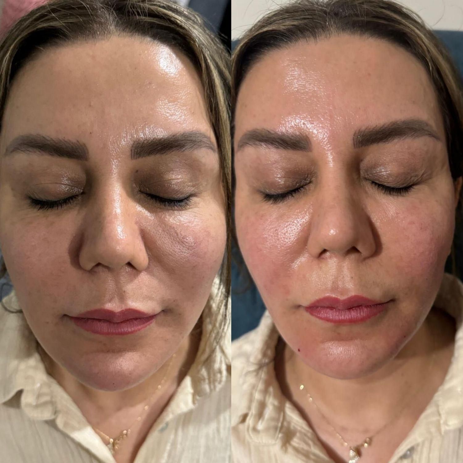 ژل بوتاکس مزوتراپی مزوژل سابسیژن/آموزش/در منزل|خدمات آرایشگری و زیبایی|تهران, تهرانپارس غربی|دیوار