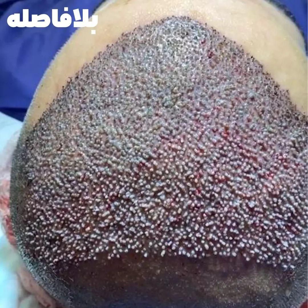 کاشت موی طبیعی|خدمات آرایشگری و زیبایی|اهواز, زیتون کارمندی|دیوار