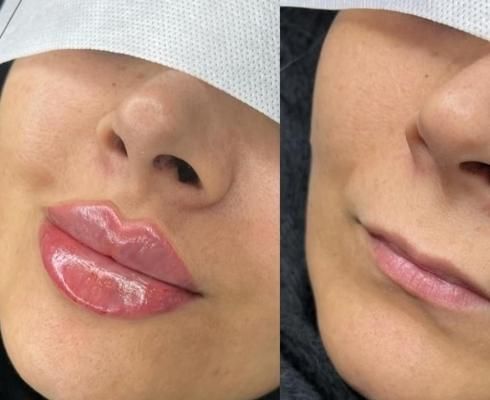 اف ژل لب وآف بوتاکس درمطب پزشک|خدمات آرایشگری و زیبایی|مشهد, احمدآباد|دیوار