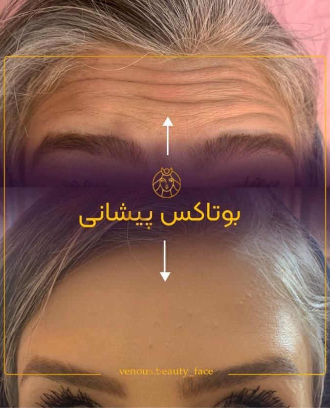 کلینیک تزریق ژل،رفع گودی زیر چشم،بوتاکس،لیزر،هایفو|خدمات آرایشگری و زیبایی|تهران, ستارخان|دیوار