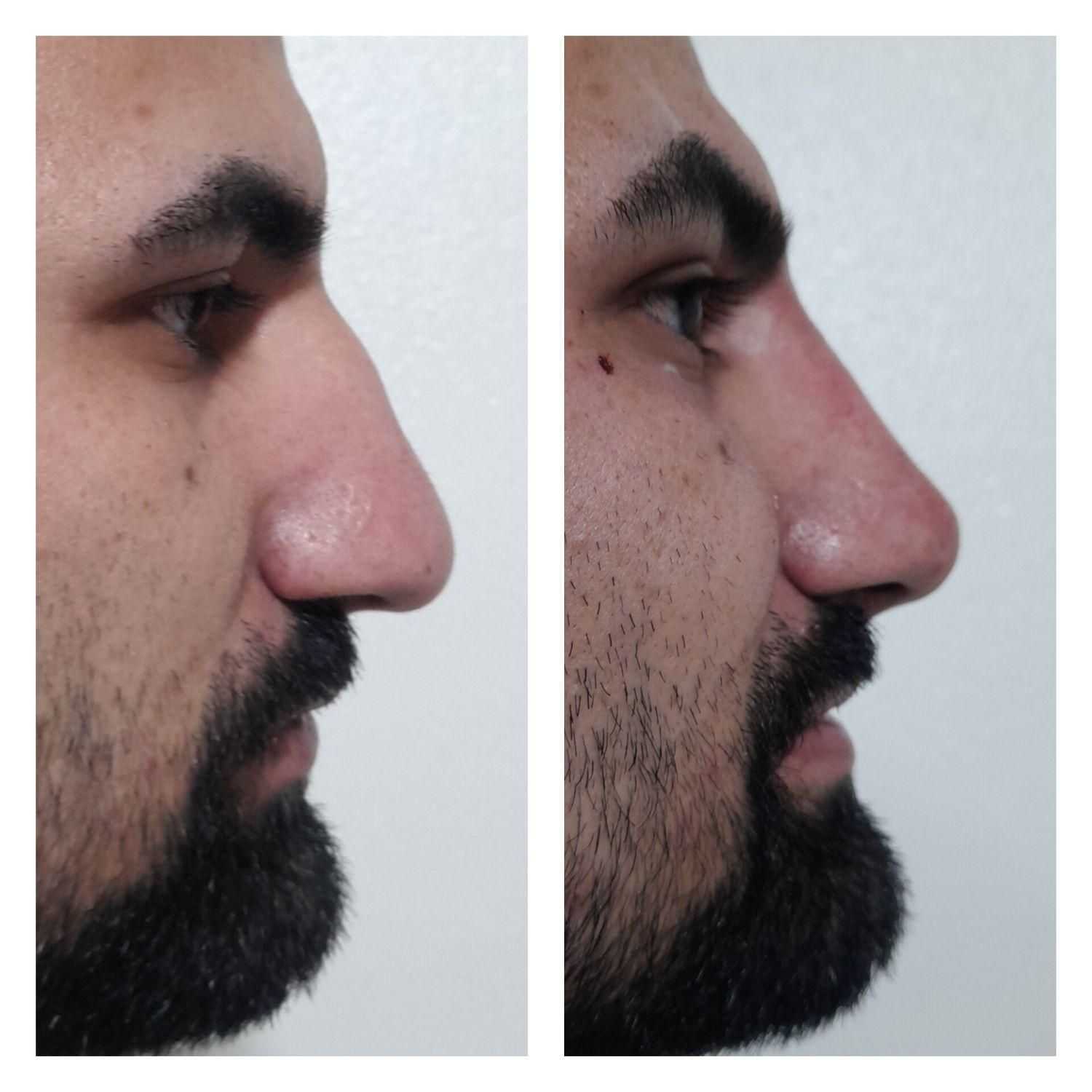 اصلاح قوز و افتادگی بینی بدون جراحی در مطب20%تخفیف|خدمات آرایشگری و زیبایی|شاهین‌شهر, فردوسی|دیوار