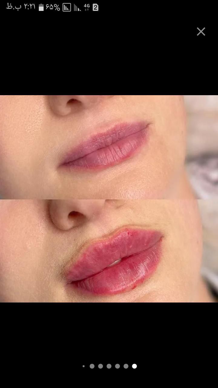 تزریق ژل وبوتاکس|خدمات آرایشگری و زیبایی|گلبهار, |دیوار