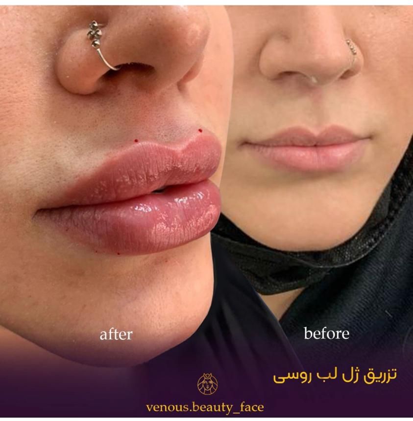 کلینیک تزریق ژل،رفع گودی زیر چشم،بوتاکس،لیزر،هایفو|خدمات آرایشگری و زیبایی|تهران, ستارخان|دیوار