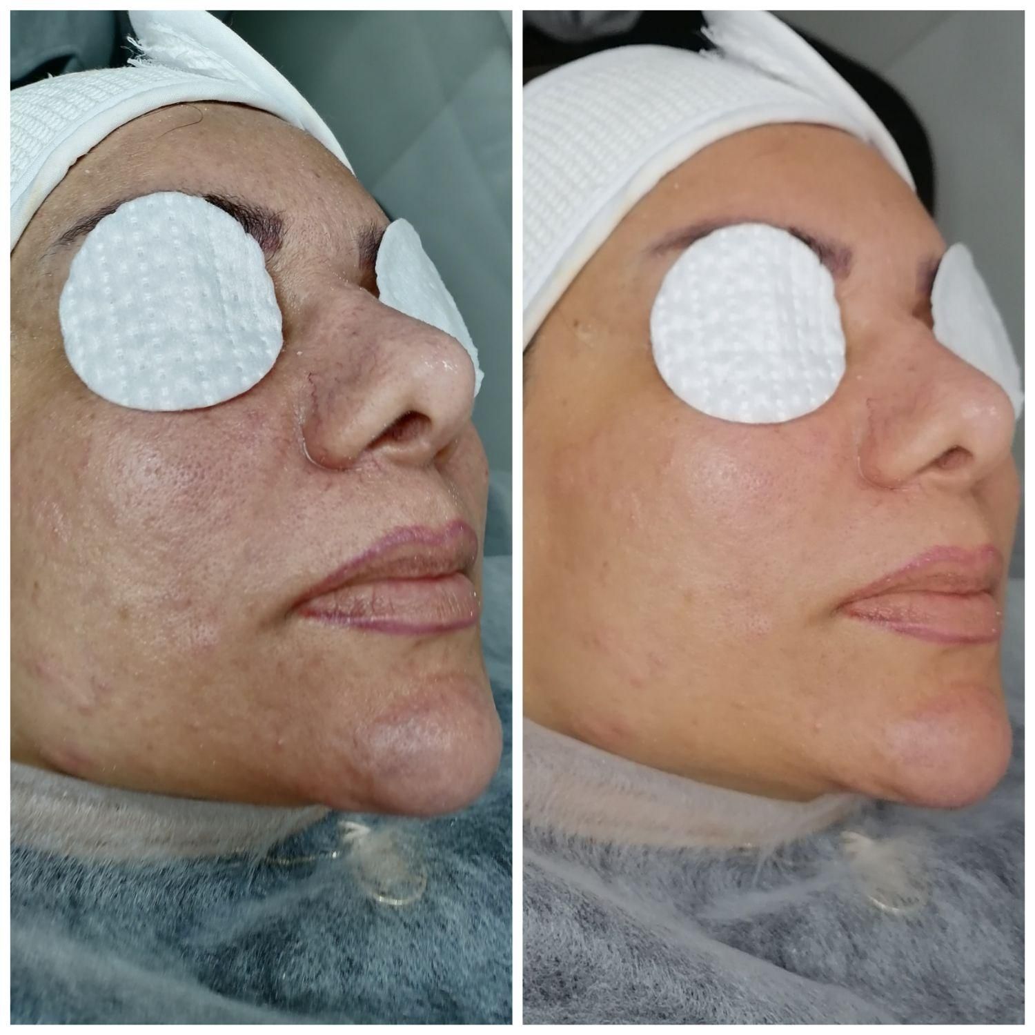 خدمات تخصصی پاکسازی فیشال صورت و بدن با دستگاه|خدمات آرایشگری و زیبایی|شاهین‌شهر, عطار|دیوار