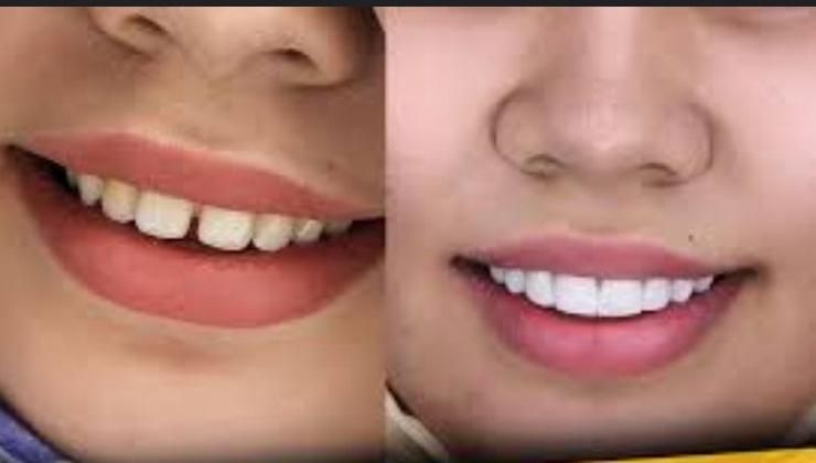 تخفیف ویژه کامپوزیت و لمینت با بهترین متخصصان|خدمات آرایشگری و زیبایی|شیراز, فرهنگ شهر|دیوار