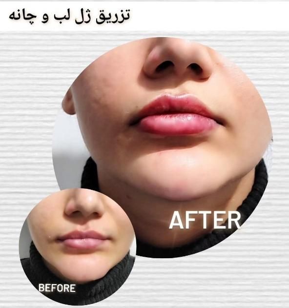 جشنواره تزریق ژل و بوتاکس و PRP برداشت خال|خدمات آرایشگری و زیبایی|تهران, بلوار کشاورز|دیوار