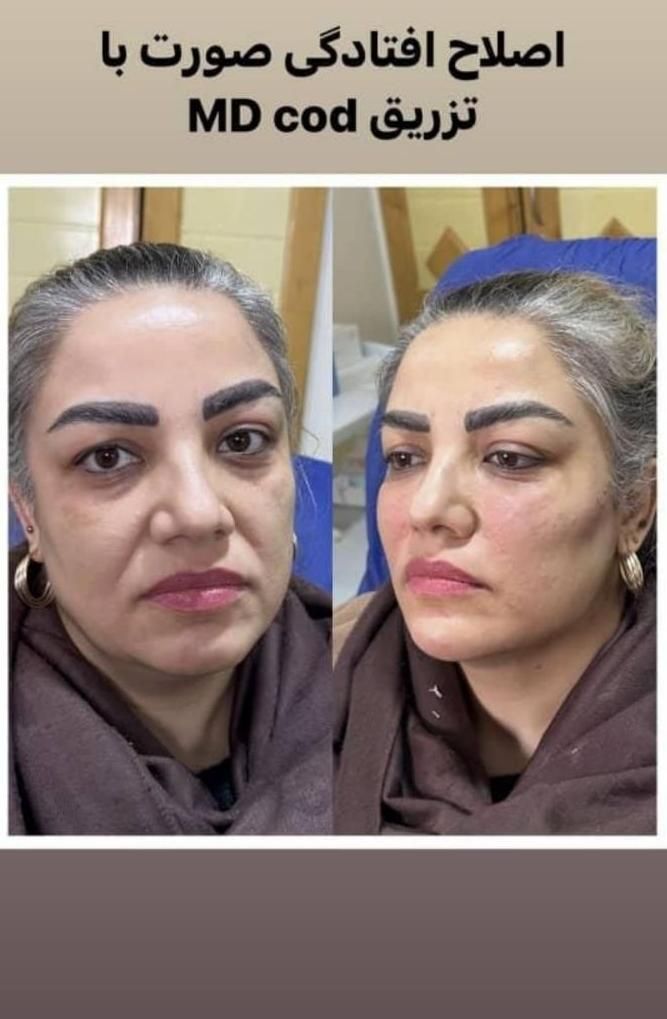 اموزش پزشک متخصص ژل.فیلر‌بوتاکس.لیفت نخ.ساکشن غبغب|خدمات آموزشی|مشهد, سناباد|دیوار