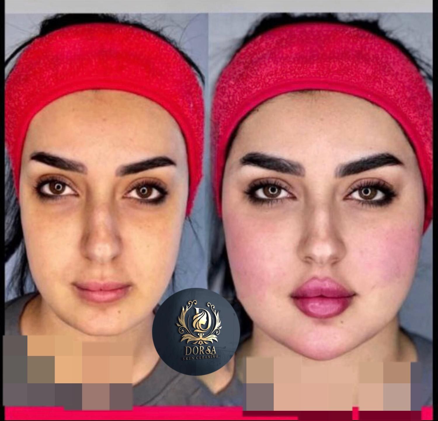 تزریق ژل و بوتاکس و مادلینگ خلیجی و هایفو درکلینیک|خدمات آرایشگری و زیبایی|کرمانشاه, |دیوار